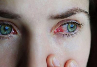 أنواع التهابات العين.. بعضها قد يسبب العمى