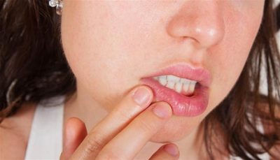 فطريات الفم الأسباب والعلاج